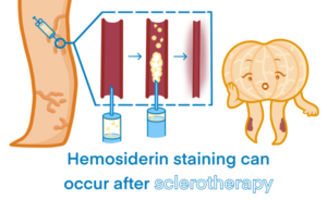 Hemosiderin Staining Why Your Legs Are Turning Brown Delaware Vein hemosiderin-staining-why-your-legs-are-turning-brown-delaware-vein